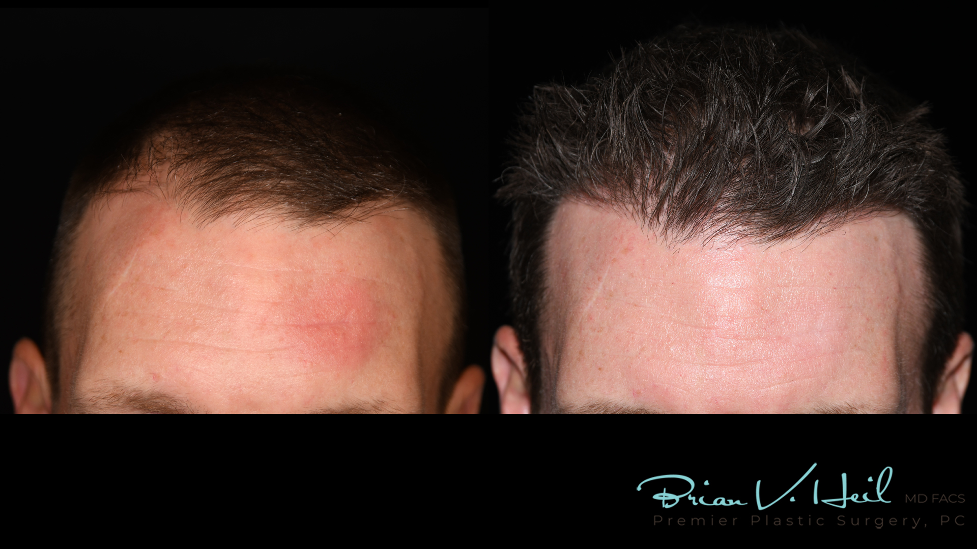 Hair Restoration Before and After | Premier Plastic Surgery