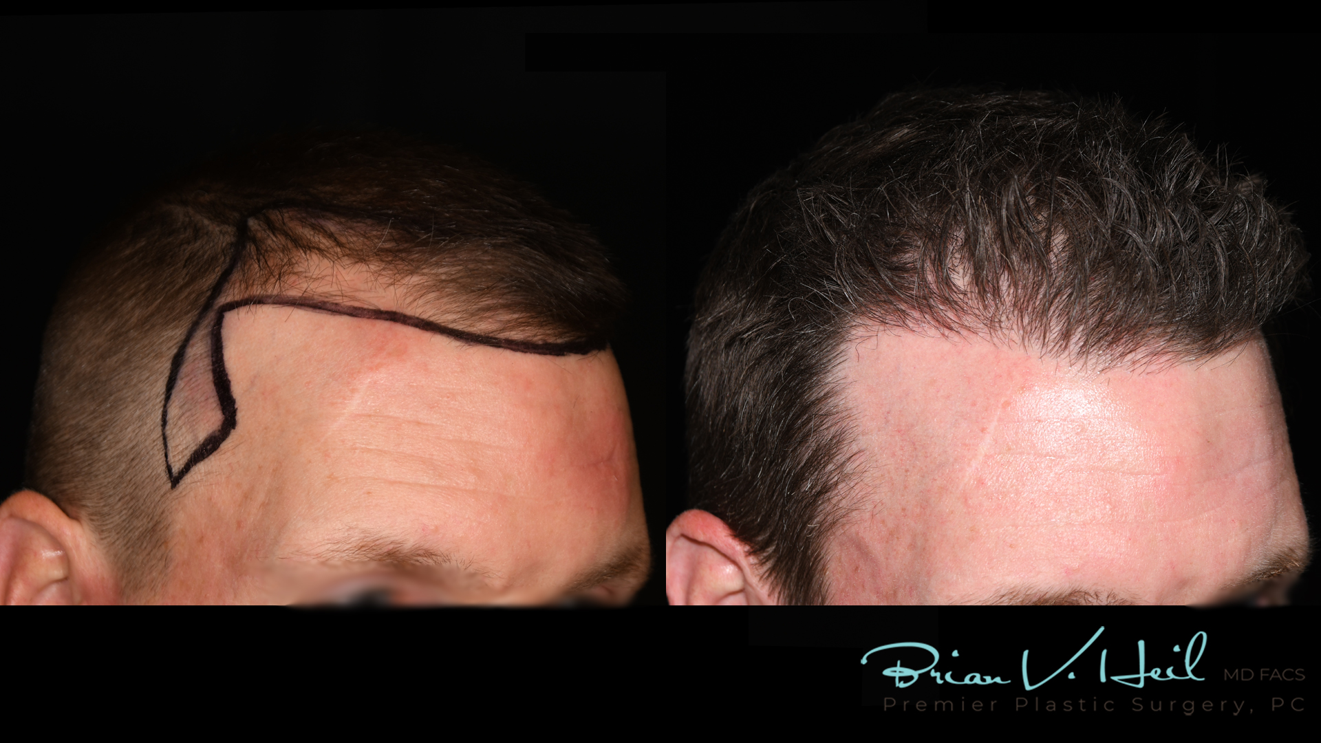 Hair Restoration Before and After | Premier Plastic Surgery