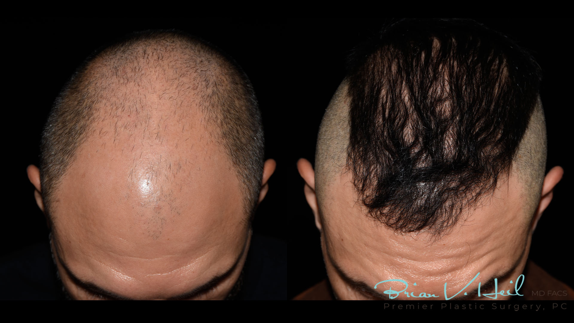 Hair Restoration Before and After | Premier Plastic Surgery