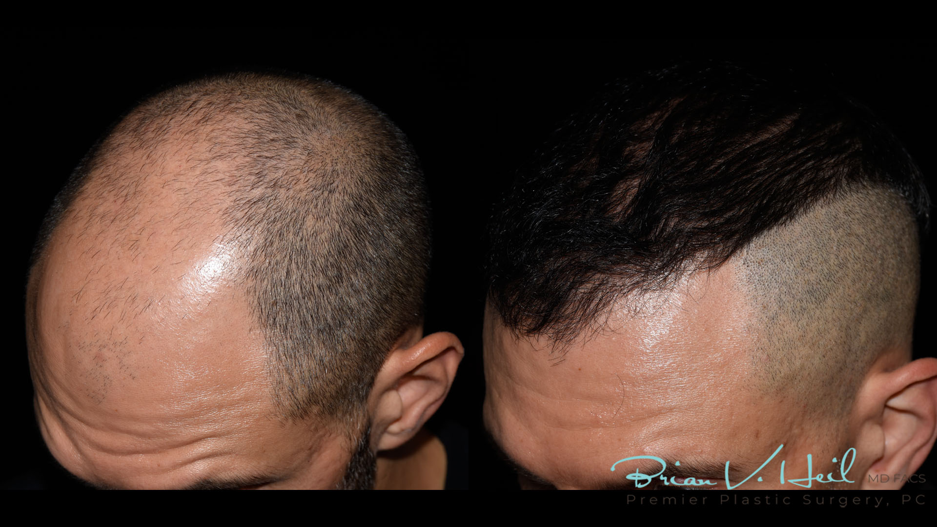 Hair Restoration Before and After | Premier Plastic Surgery