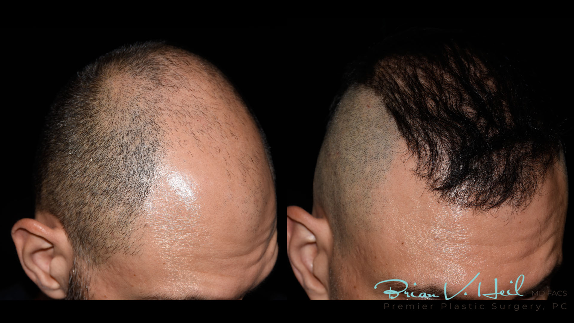 Hair Restoration Before and After | Premier Plastic Surgery