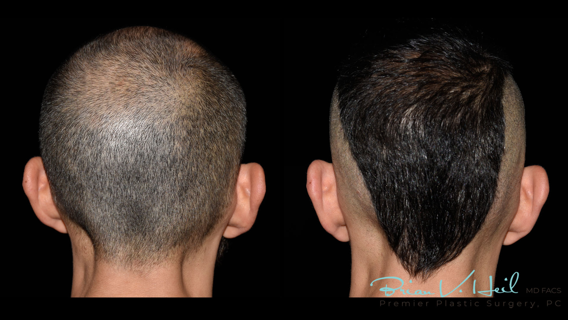 Hair Restoration Before and After | Premier Plastic Surgery