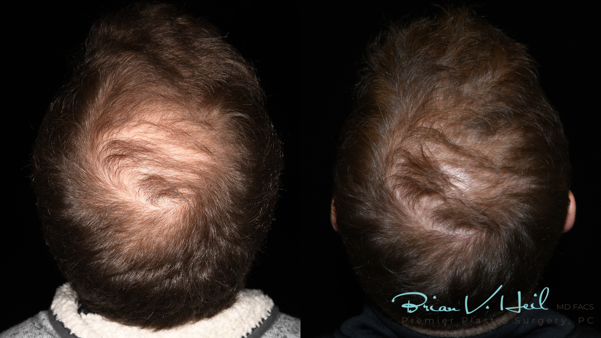 Hair Restoration Before and After | Premier Plastic Surgery