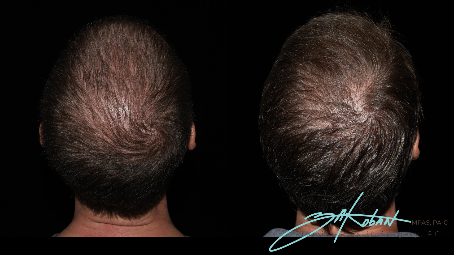 Hair Restoration Before and After | Premier Plastic Surgery