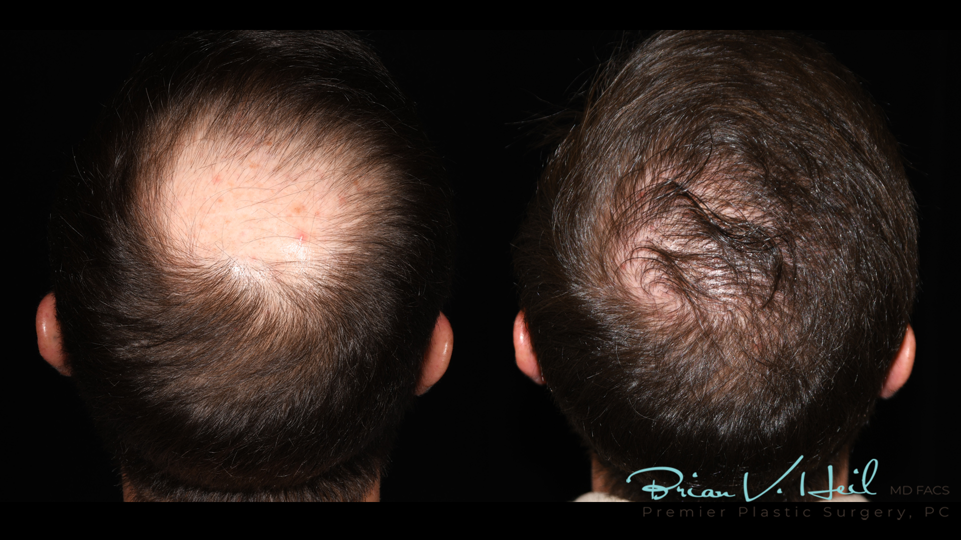 Hair Restoration Before and After | Premier Plastic Surgery