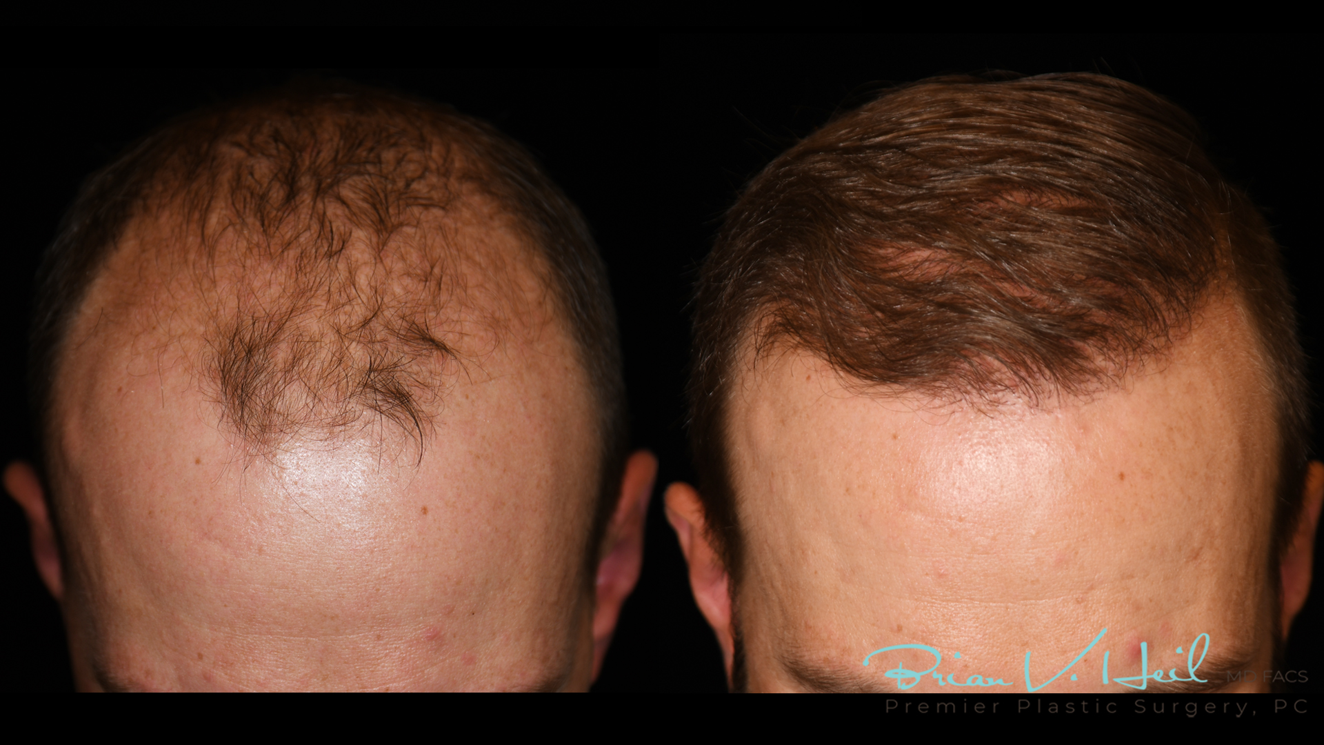 Hair Restoration Before and After | Premier Plastic Surgery