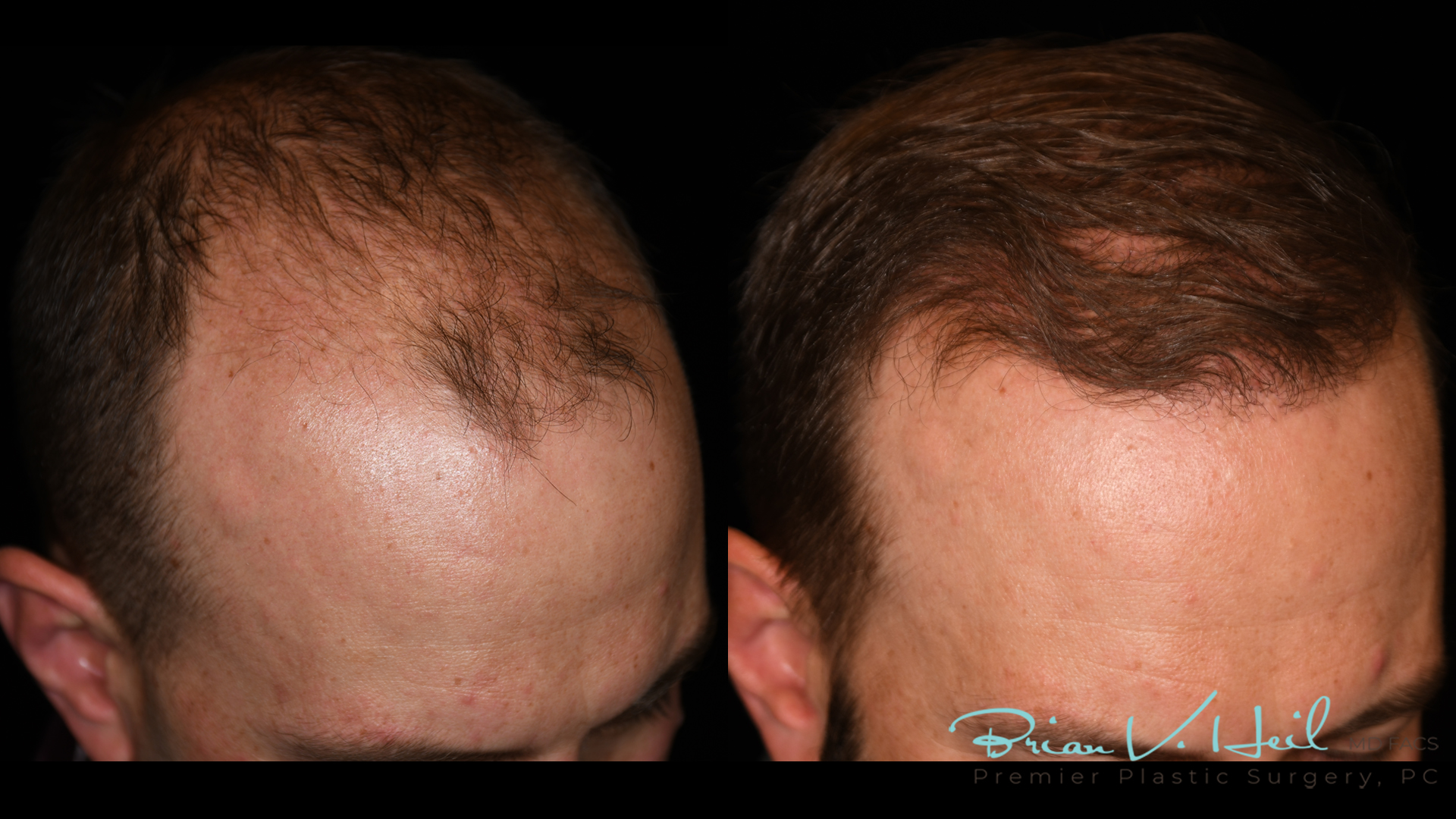 Hair Restoration Before and After | Premier Plastic Surgery