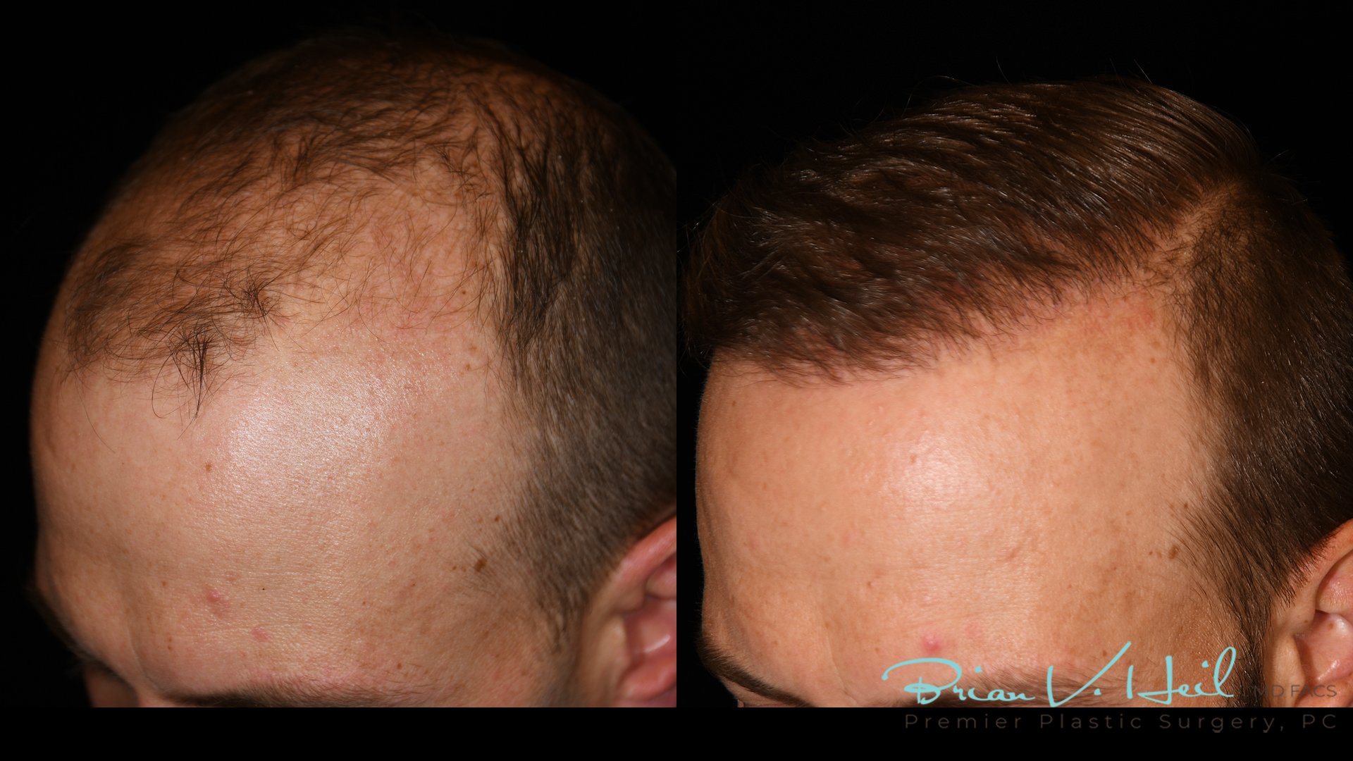 Hair Restoration Before and After | Premier Plastic Surgery