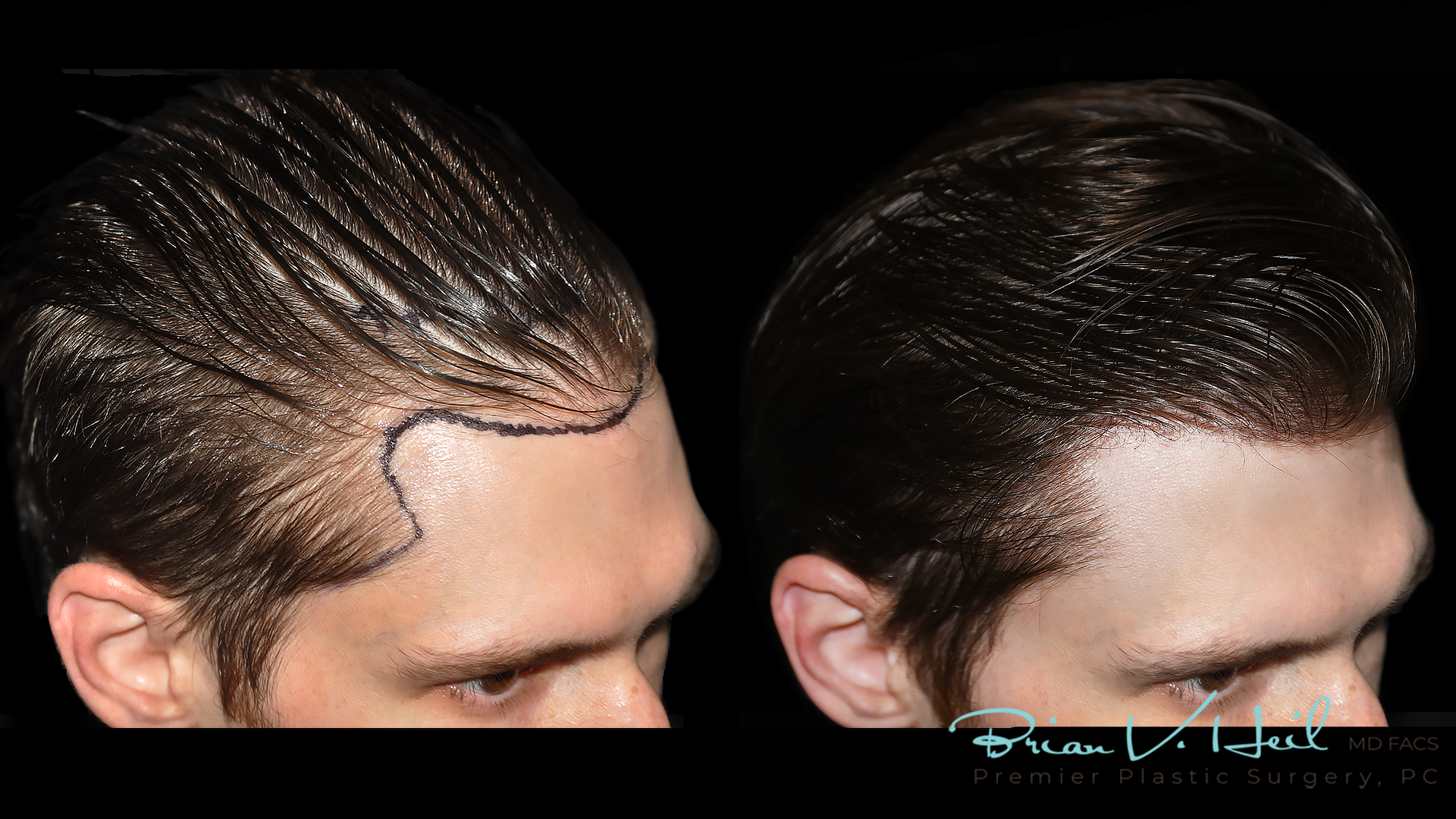 Hair Restoration Before and After | Premier Plastic Surgery