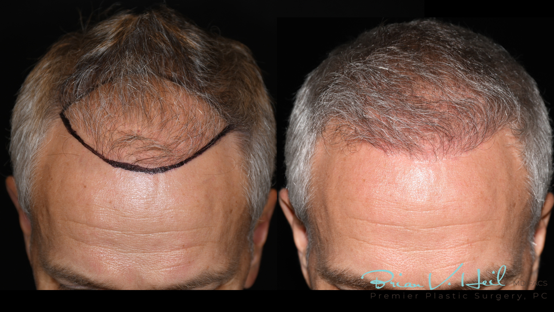 Hair Restoration Before and After | Premier Plastic Surgery