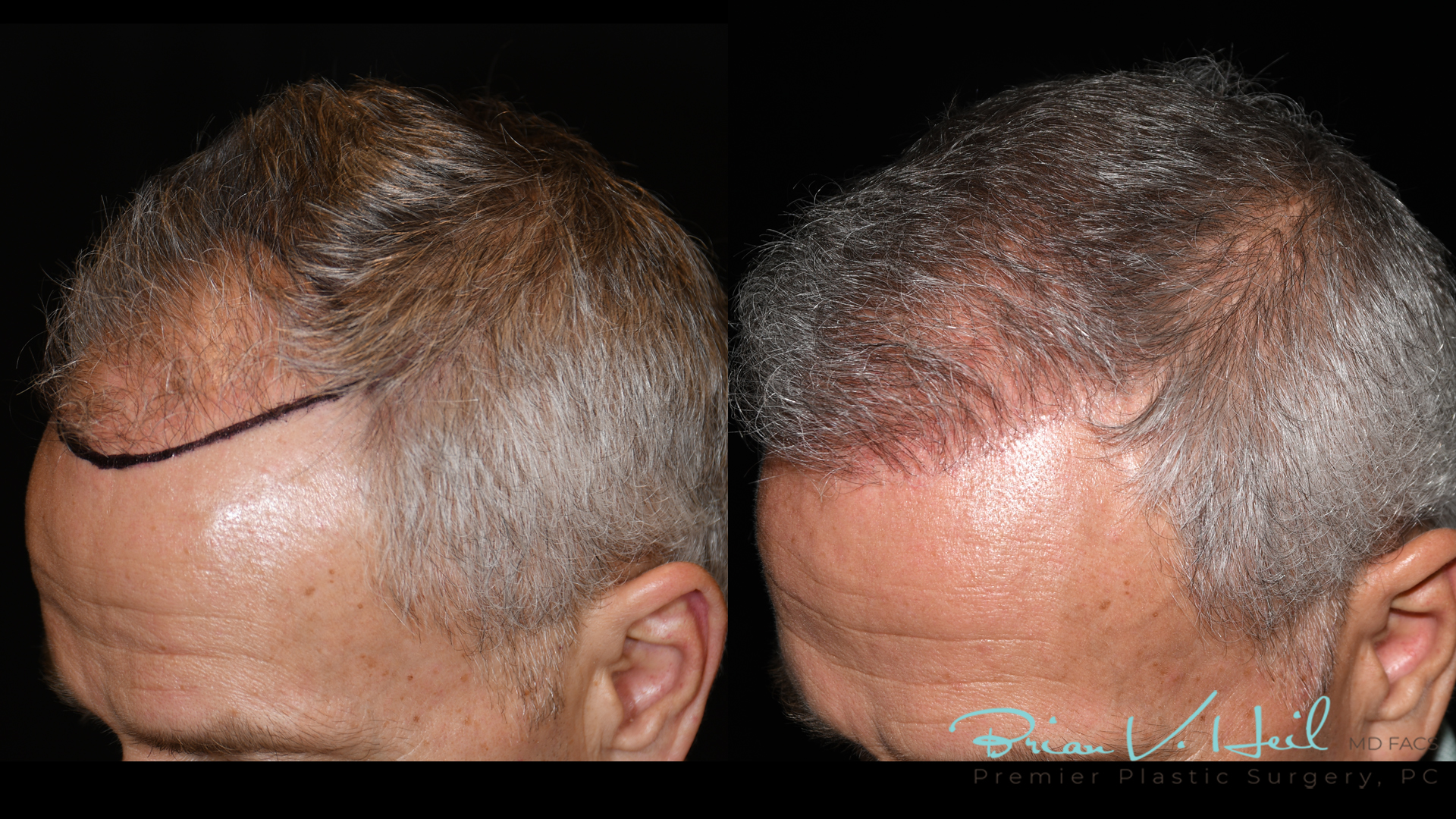 Hair Restoration Before and After | Premier Plastic Surgery