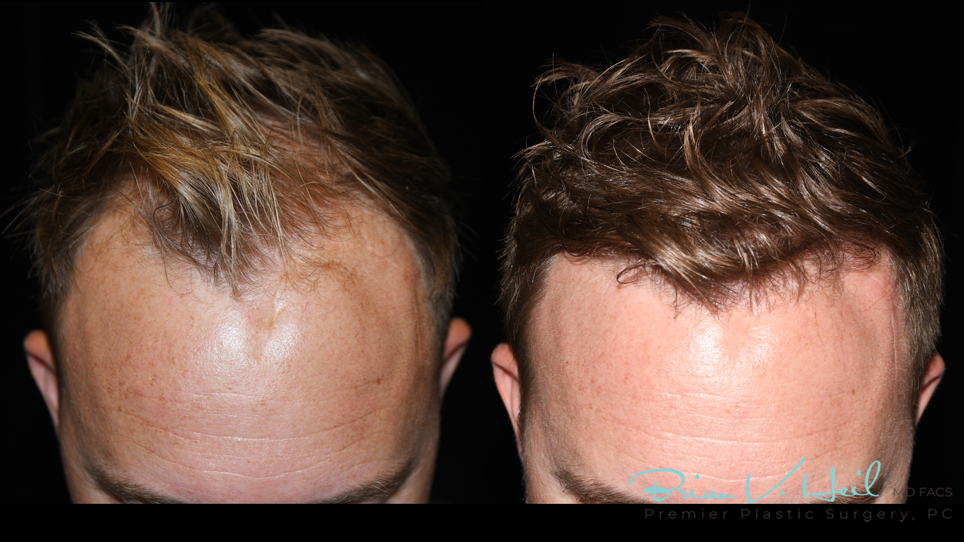 Hair Restoration Before and After | Premier Plastic Surgery