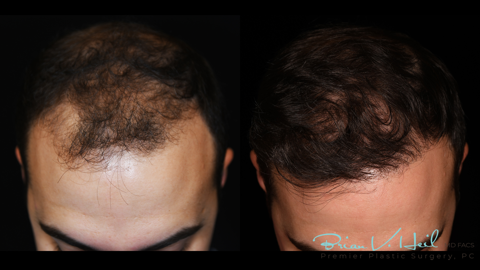 Hair Restoration Before and After | Premier Plastic Surgery