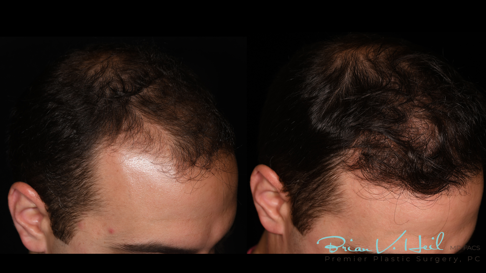 Hair Restoration Before and After | Premier Plastic Surgery