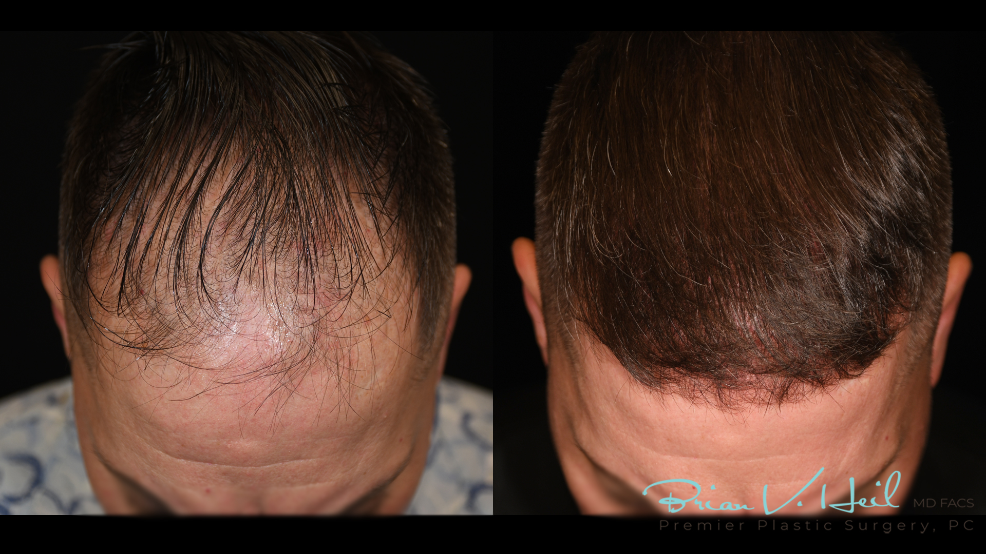 Hair Restoration Before and After | Premier Plastic Surgery