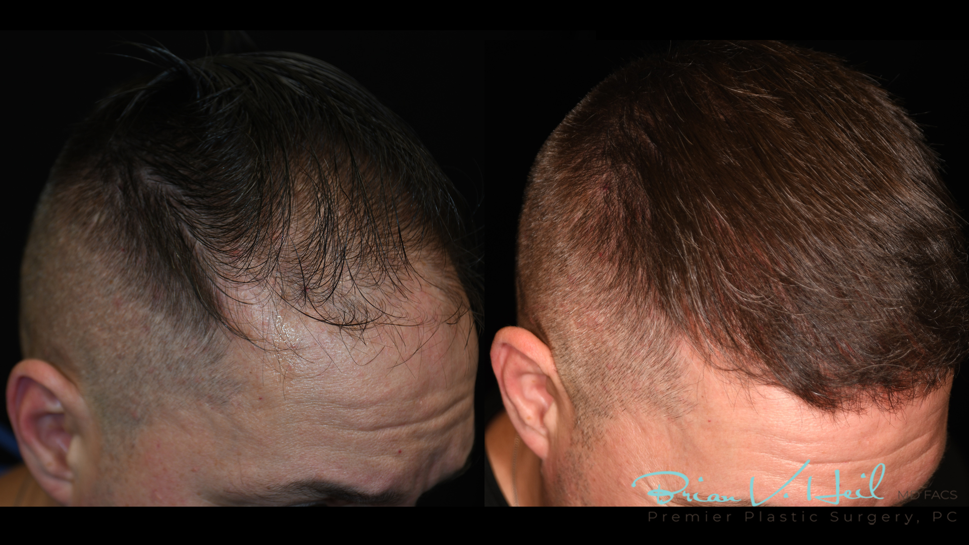 Hair Restoration Before and After | Premier Plastic Surgery