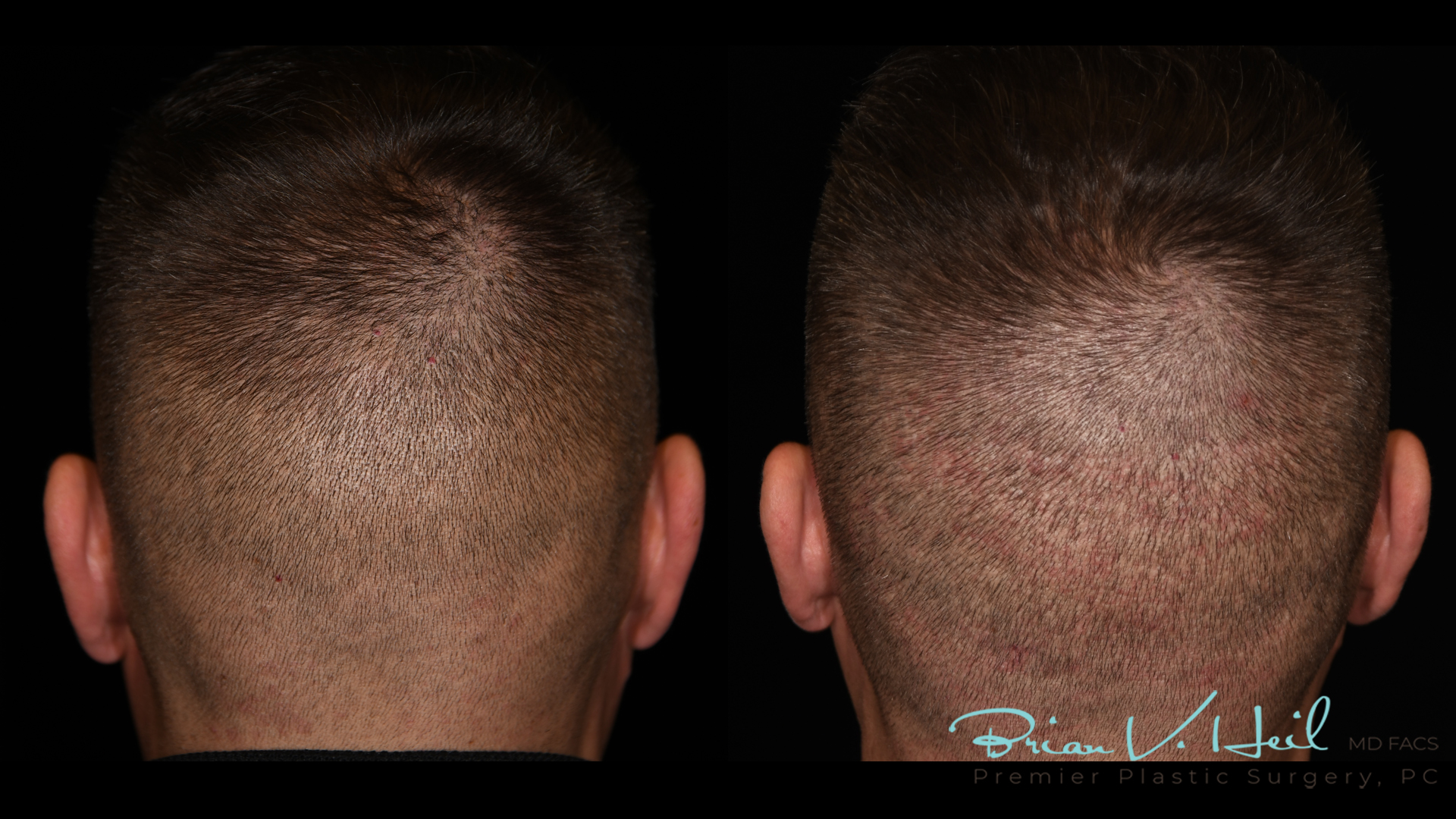 Hair Restoration Before and After | Premier Plastic Surgery