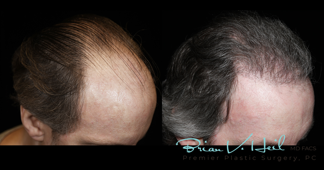 Hair Restoration Before and After | Premier Plastic Surgery