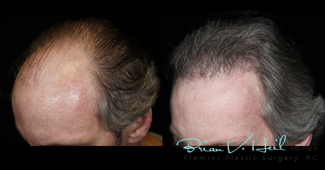 Hair Restoration Before and After | Premier Plastic Surgery