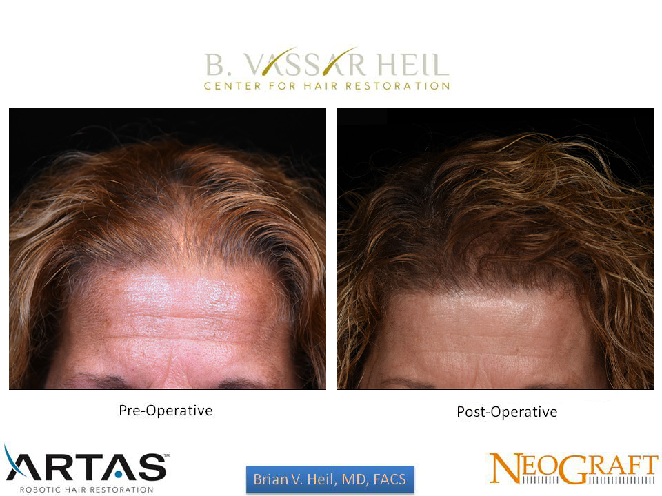 Hair Restoration Before and After | Premier Plastic Surgery