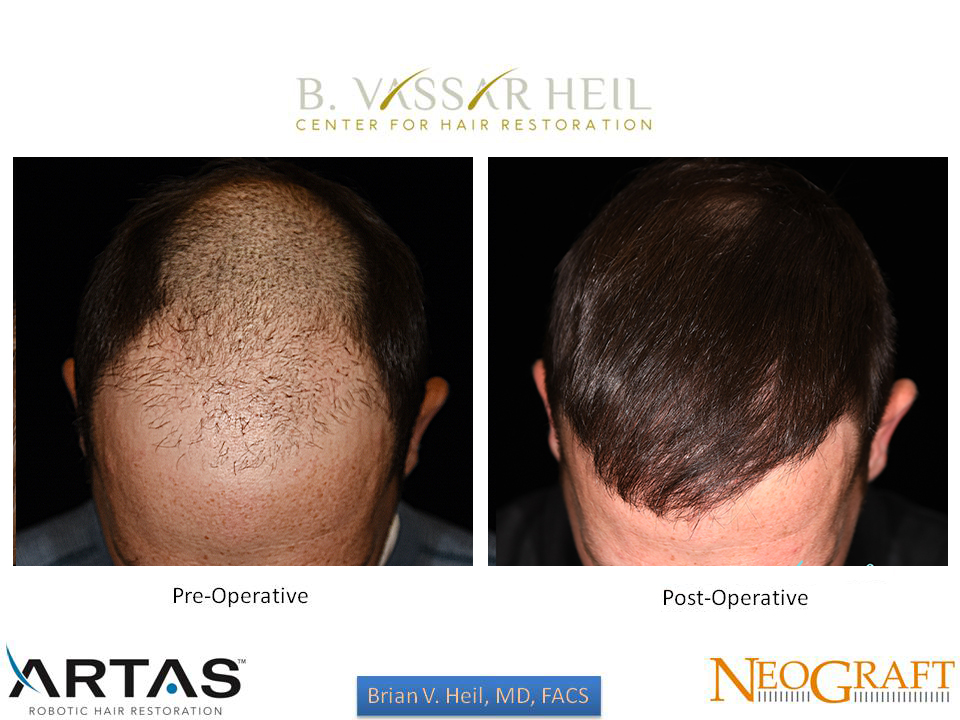 Hair Restoration Before and After | Premier Plastic Surgery