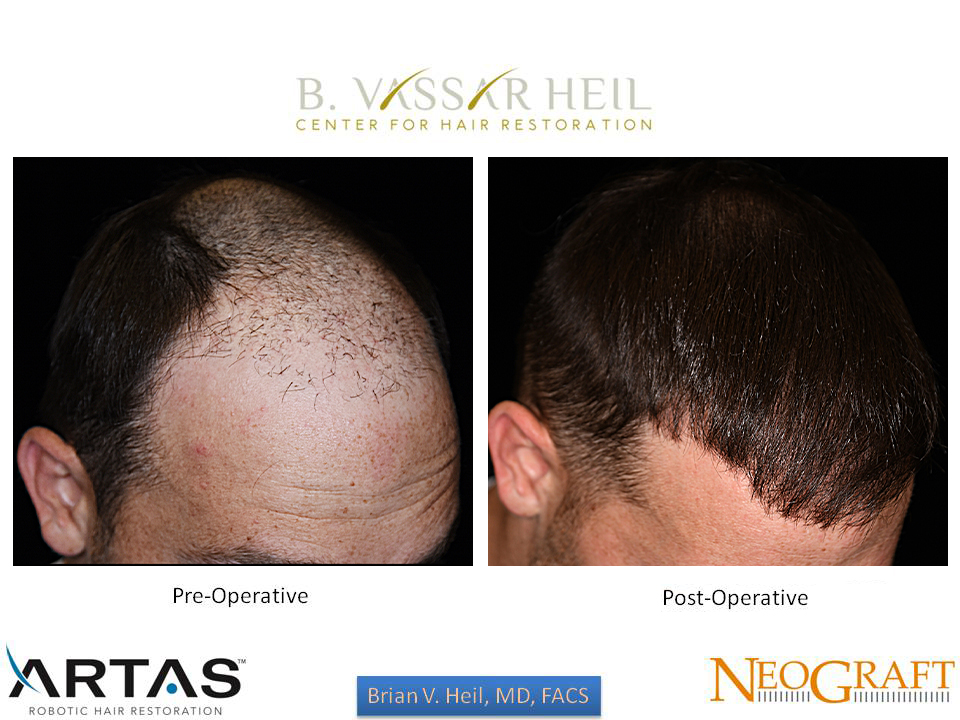 Hair Restoration Before and After | Premier Plastic Surgery