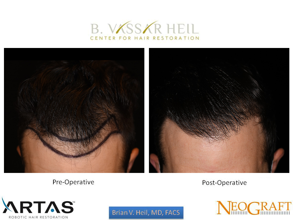 Hair Restoration Before and After | Premier Plastic Surgery