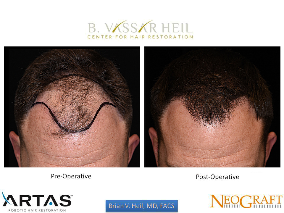 Hair Restoration Before and After | Premier Plastic Surgery