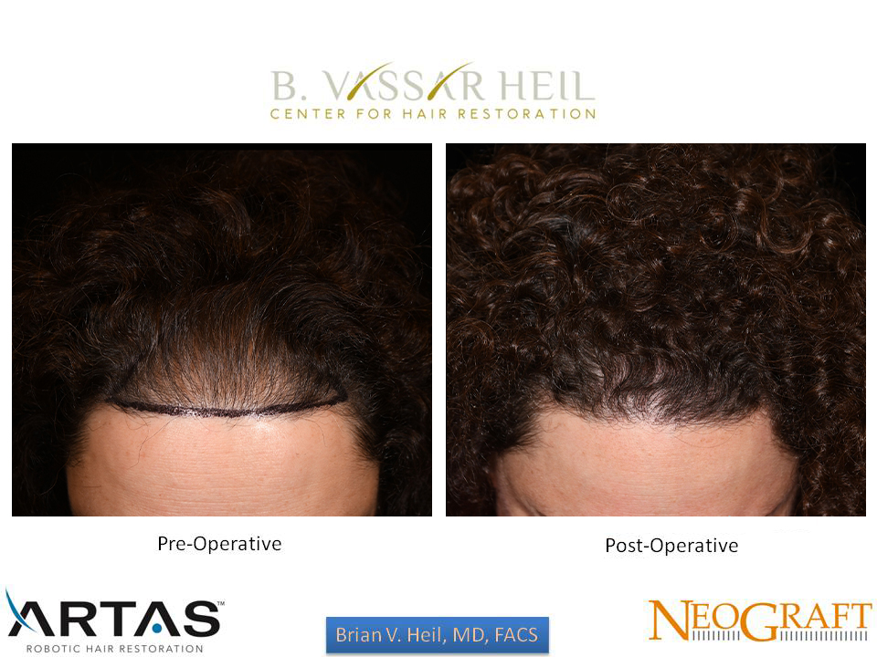 Hair Restoration Before and After | Premier Plastic Surgery