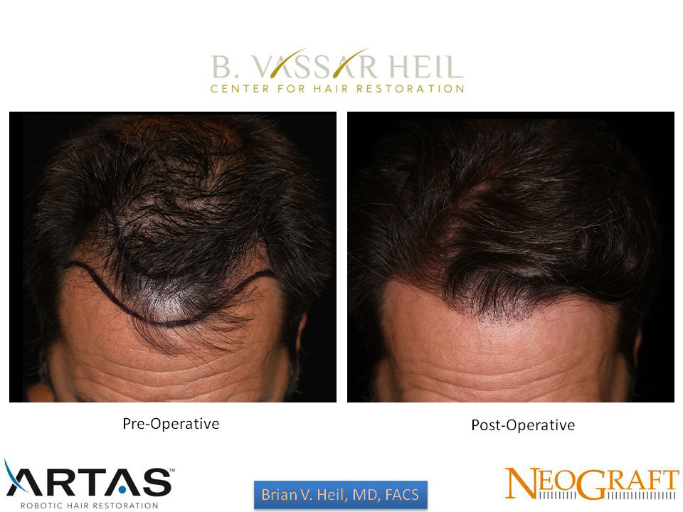 Hair Restoration Before and After | Premier Plastic Surgery