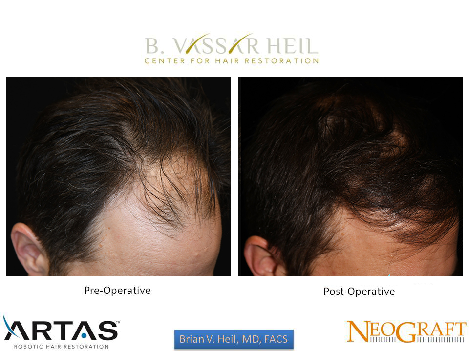 Hair Restoration Before and After | Premier Plastic Surgery