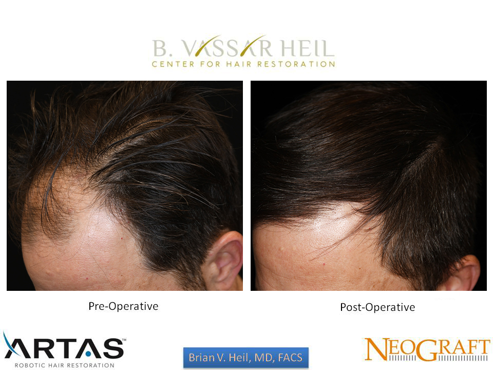 Hair Restoration Before and After | Premier Plastic Surgery