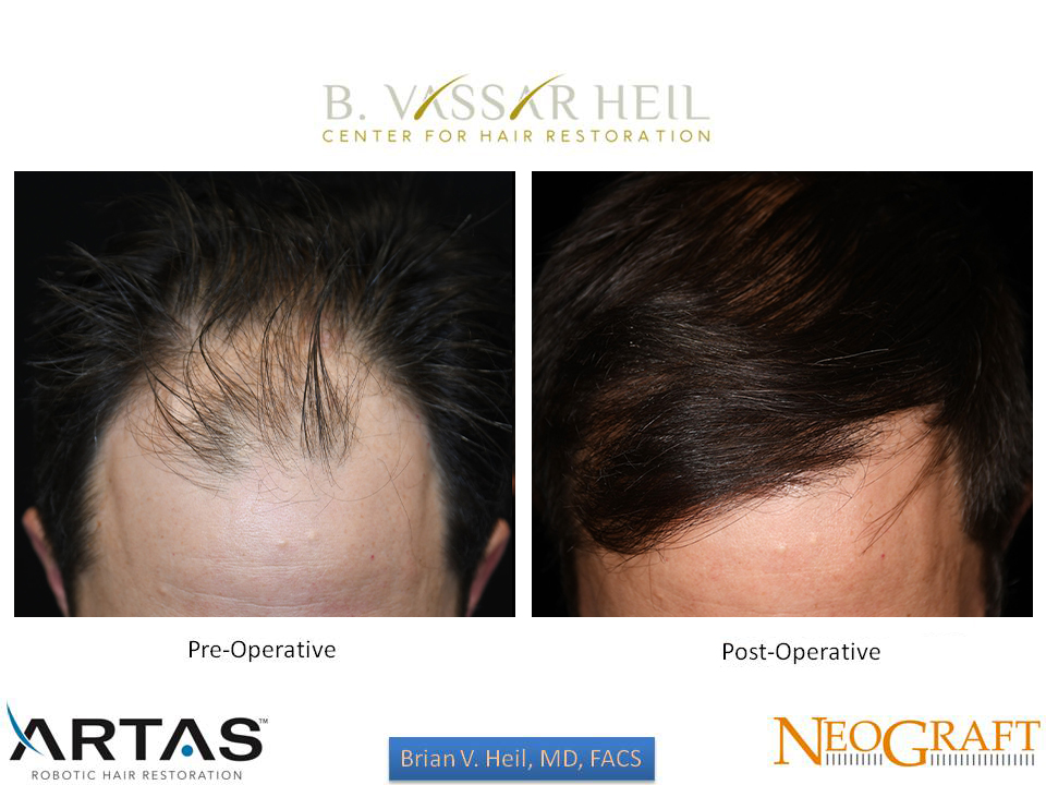 Hair Restoration Before and After | Premier Plastic Surgery