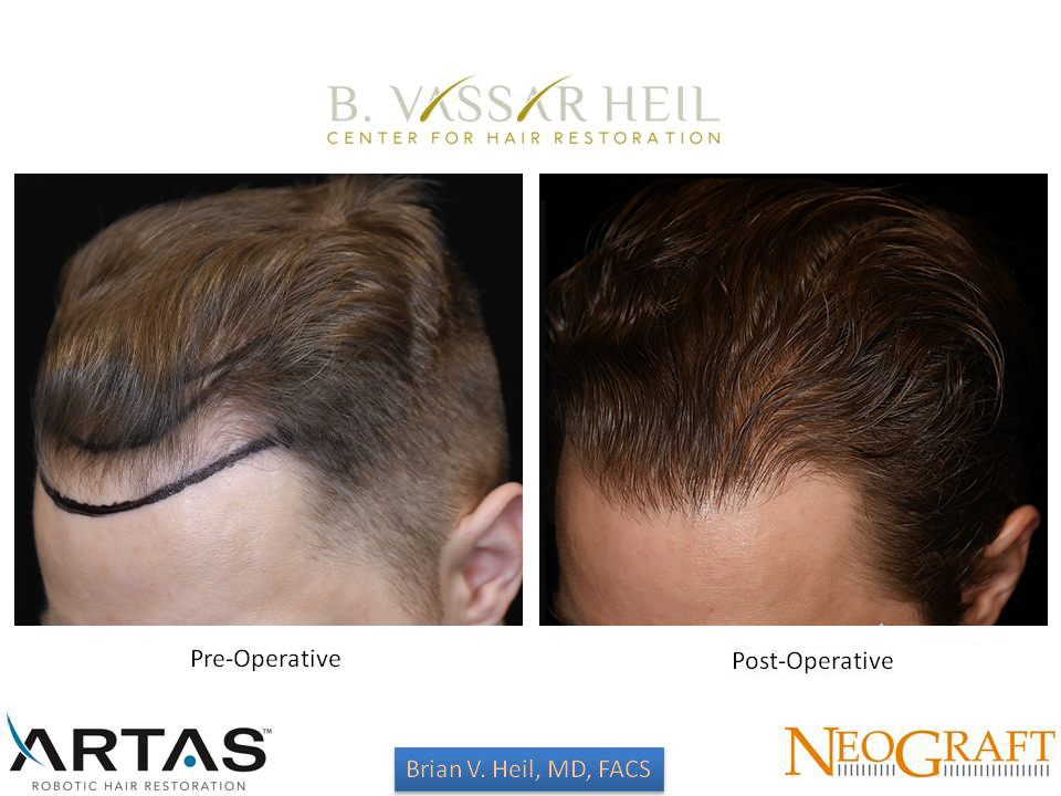 Hair Restoration Before and After | Premier Plastic Surgery