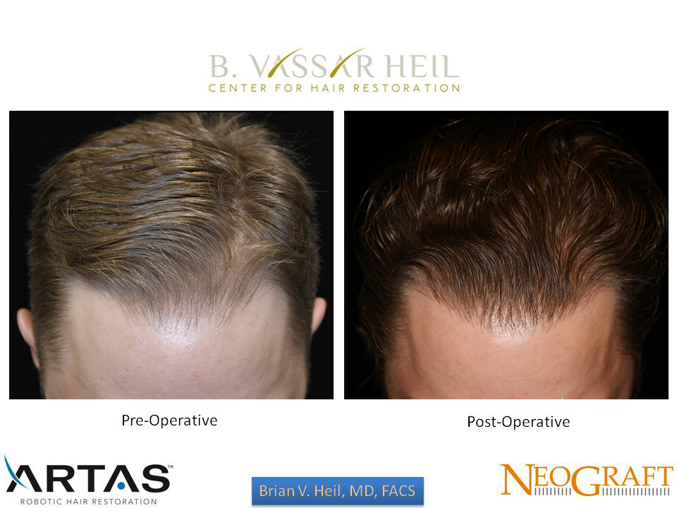 Hair Restoration Before and After | Premier Plastic Surgery