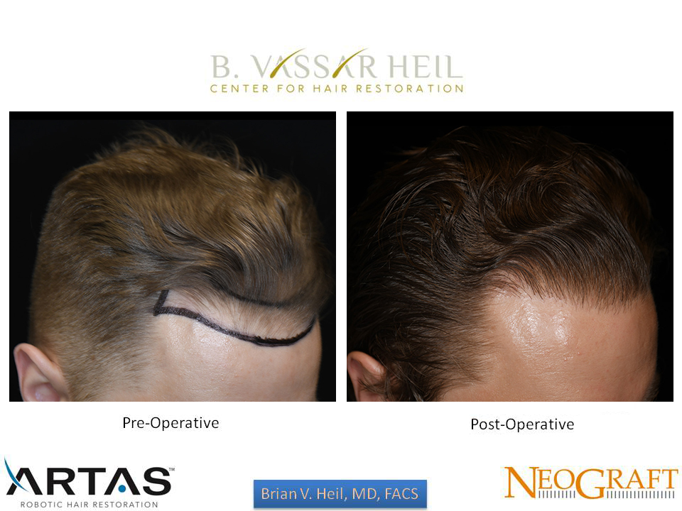 Hair Restoration Before and After | Premier Plastic Surgery