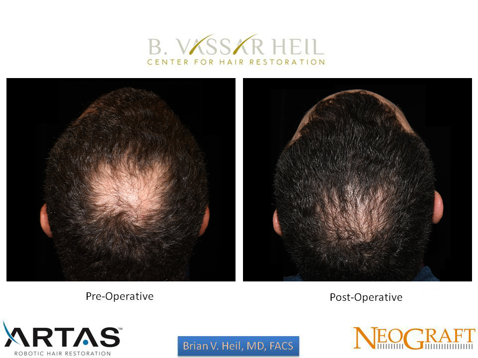 Hair Restoration Before and After | Premier Plastic Surgery