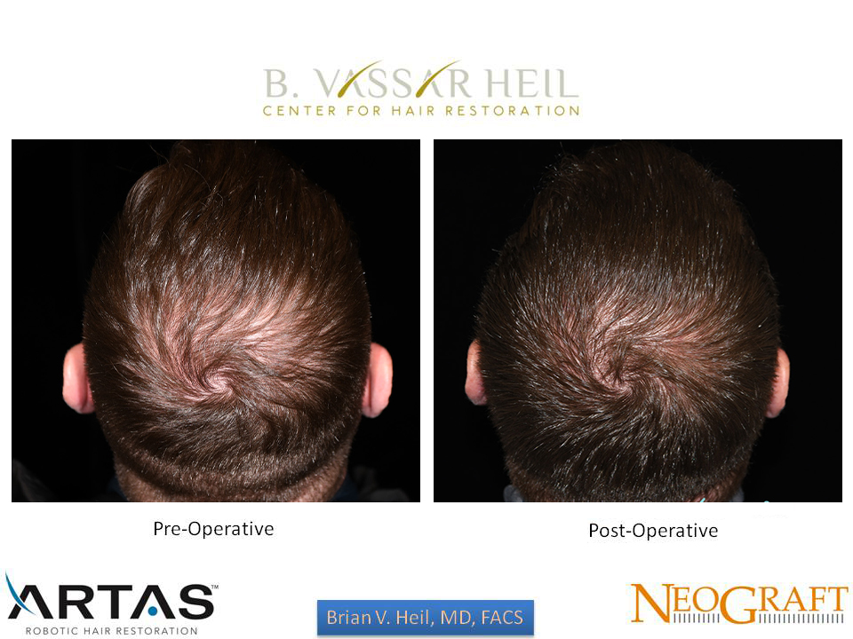 Hair Restoration Before and After | Premier Plastic Surgery