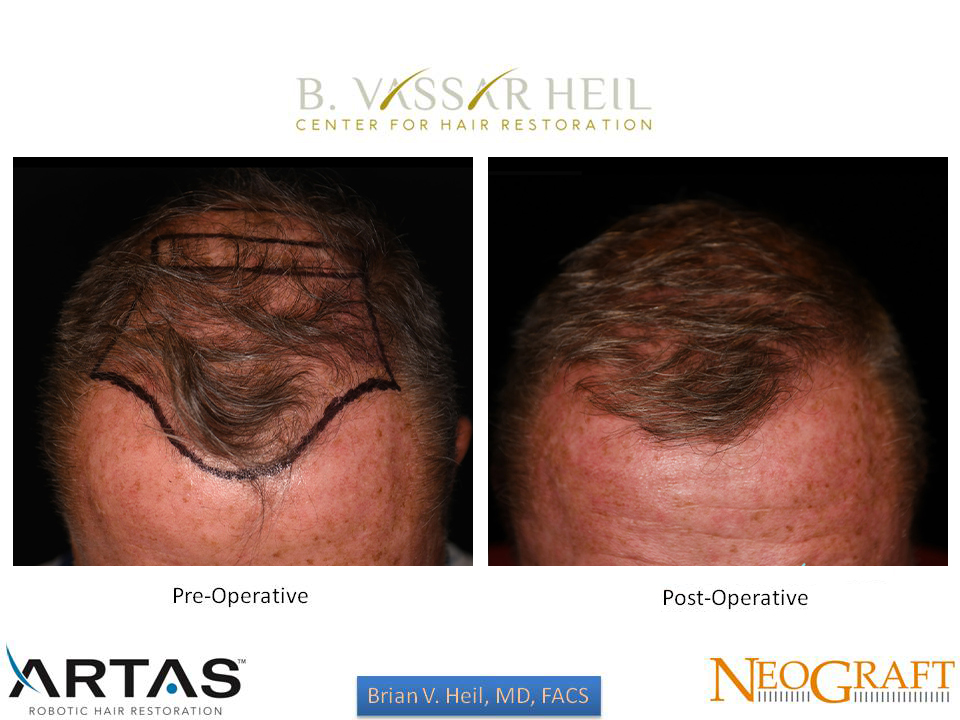 Hair Restoration Before and After | Premier Plastic Surgery