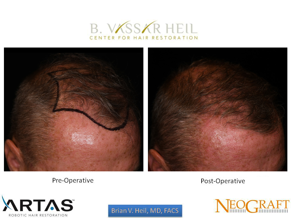 Hair Restoration Before and After | Premier Plastic Surgery