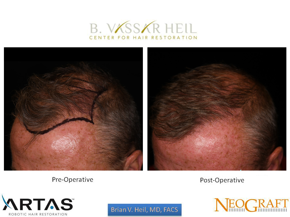 Hair Restoration Before and After | Premier Plastic Surgery