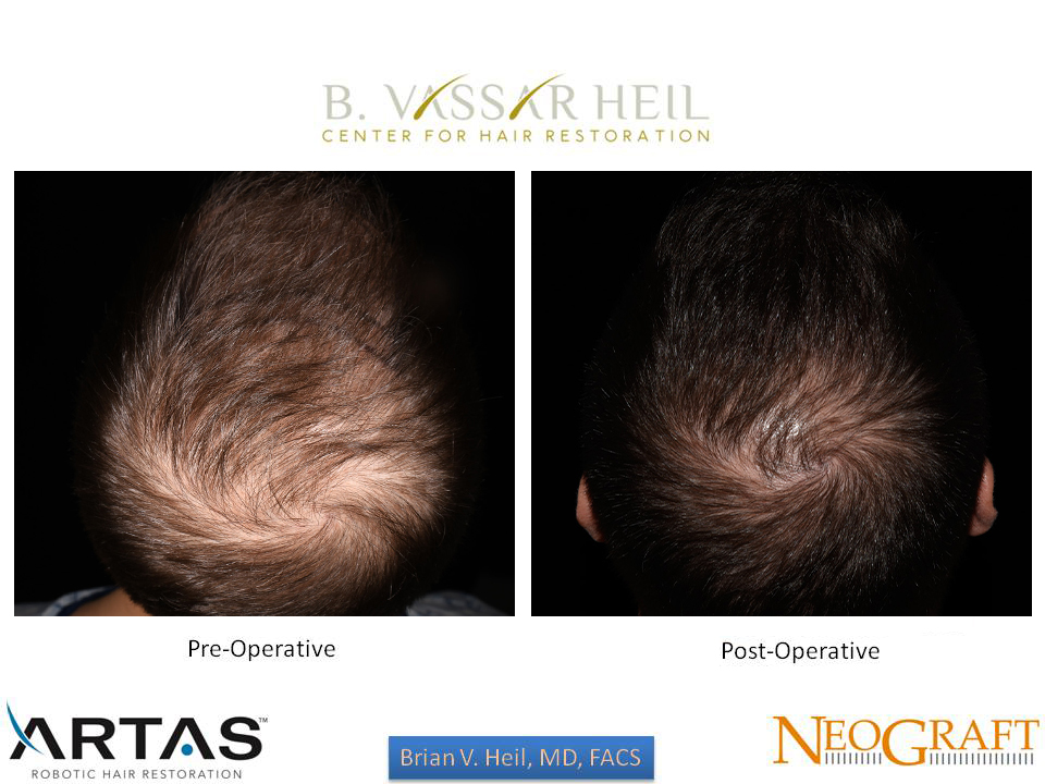 Hair Restoration Before and After | Premier Plastic Surgery