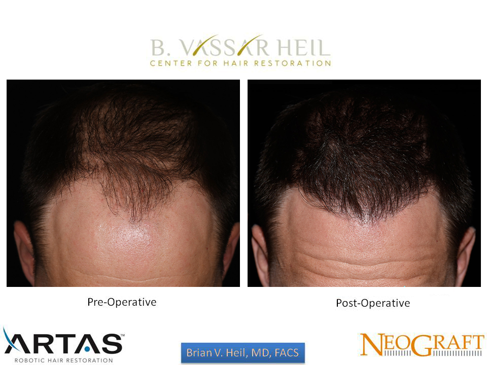 Hair Restoration Before and After | Premier Plastic Surgery