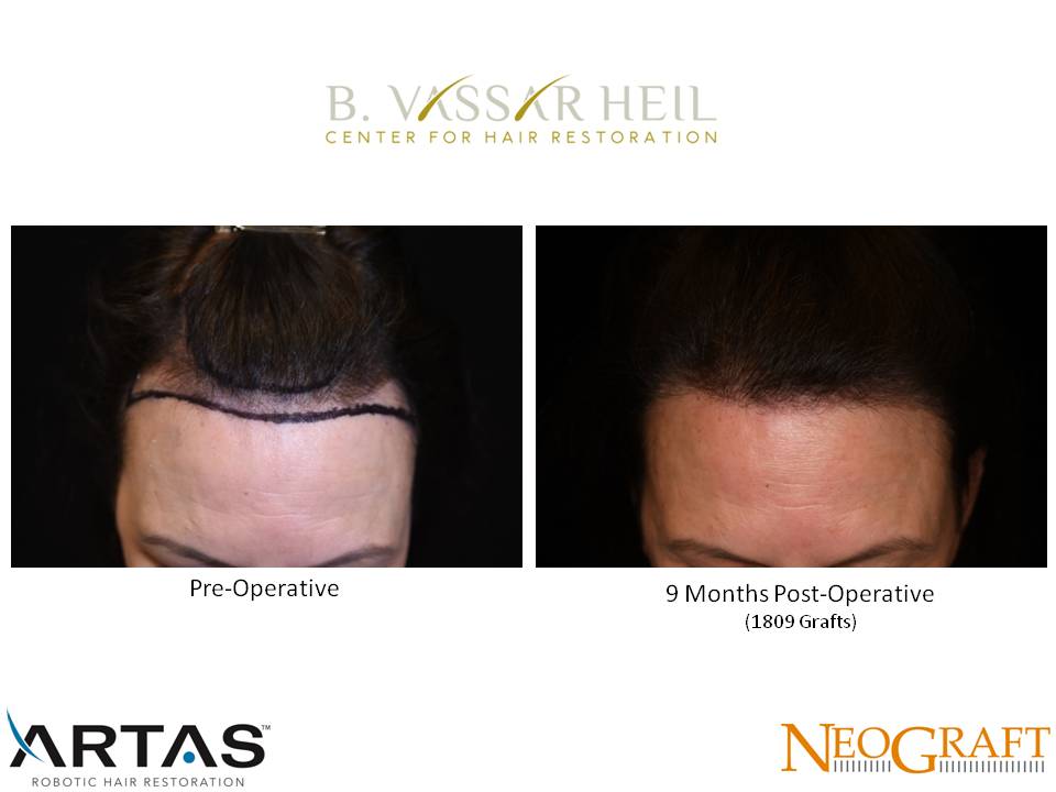 Hair Restoration Before and After | Premier Plastic Surgery