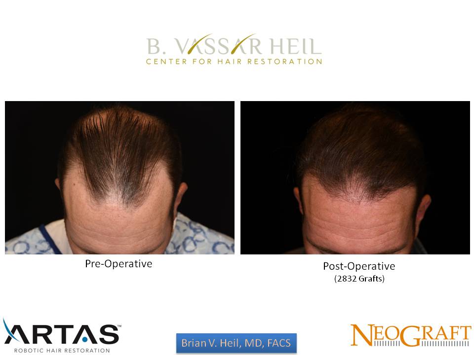 Hair Restoration Before and After | Premier Plastic Surgery