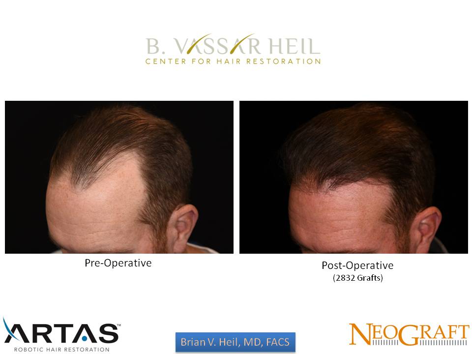 Hair Restoration Before and After | Premier Plastic Surgery