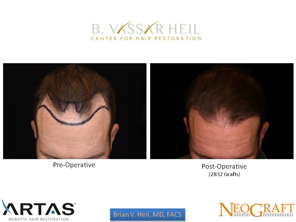 Hair Restoration Before and After | Premier Plastic Surgery