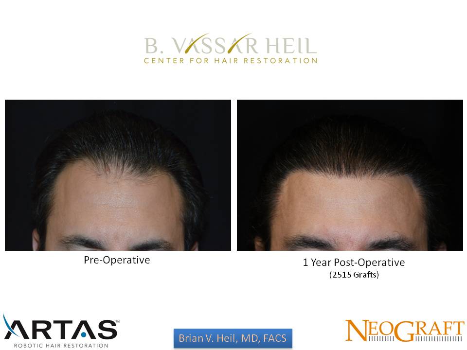 Hair Restoration Before and After | Premier Plastic Surgery