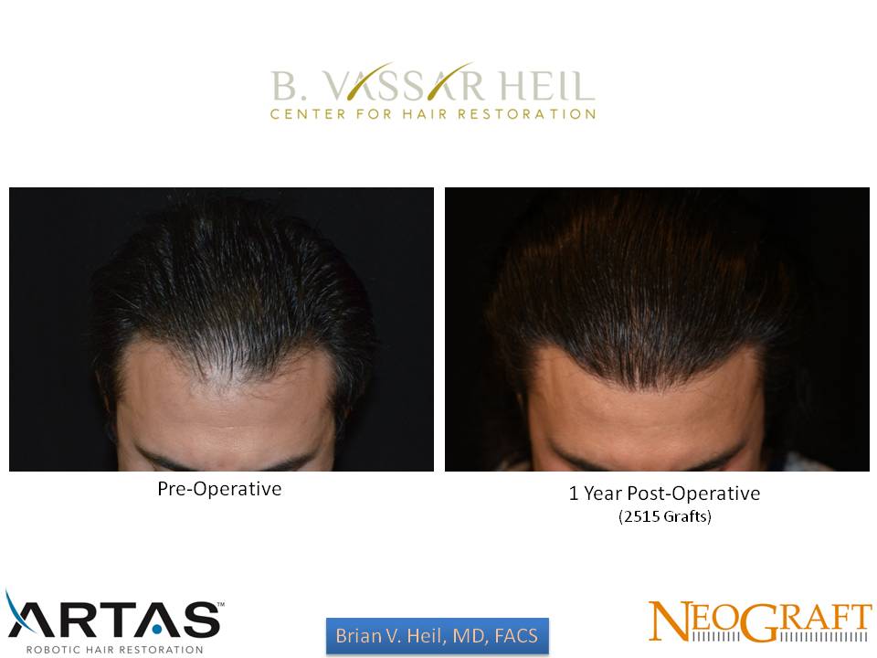 Hair Restoration Before and After | Premier Plastic Surgery