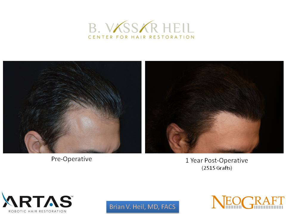 Hair Restoration Before and After | Premier Plastic Surgery